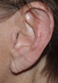 65 Year Old Female Treated For Big Earlobes With Wrinkles