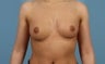 Breast Implants