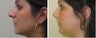 Rhinoplasty Before & After