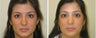 Rhinoplasty Before & After