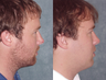 Rhinoplasty