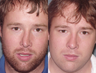 Rhinoplasty