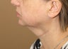 Neck lift 