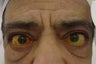 Lower Blephroplasty