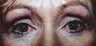 Female patient who underwent laser surgery 