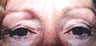 Female patient who underwent laser surgery 