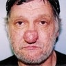 Male patient who underwent nose surgery 
