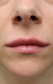 Lip Augmentation