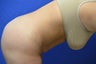 SmartLipo of the Lower abdomen