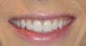 Juvederm XC