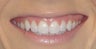 Juvederm XC