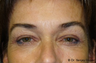 Eyelid Sugery