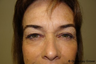 Eyelid Sugery