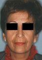 Revision Rhinoplasty