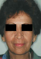 Revision Rhinoplasty