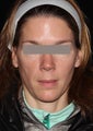 Female patient before and after Botox.