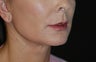 Facelift