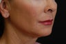 Facelift