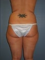 Liposuction