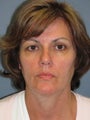 Neck Lift on 52-year-old