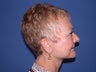 Neck lift