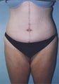 Weight Loss