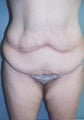 Weight Loss