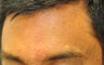 Scar Treatment