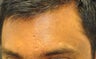 Scar Treatment
