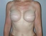 54 year old female patient 
