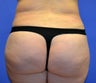 38 year old woth lack of gluteal volume