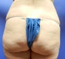 38 year old woth lack of gluteal volume