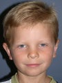 Otoplasty/Ear Surgery