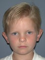 Otoplasty/Ear Surgery