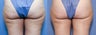 33 year old female treated for cellulite