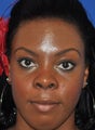 African American Rhinoplasty