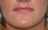 Before and After Lip Lift