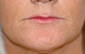 Before and After Lip Lift