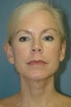 Facelift