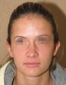 rhinoplasty - nose job photos
