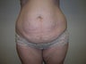Tummy Tuck