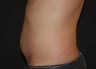 Liposuction