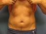 Exilis