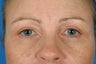 Eyelid Surgery