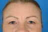 Eyelid Surgery