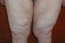 61 year old woman has Thigh Lift surgery