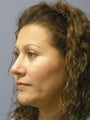 Nose Surgery