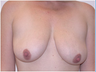 Breast Lift