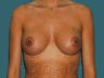 Breast Augmentation
