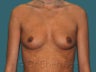 Breast Augmentation